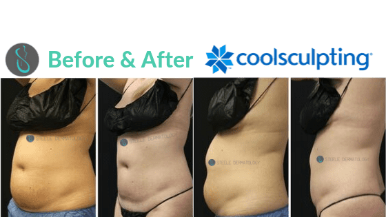 side by side image of before and after of woman's mid section after cool sculpting treatments at steele dermatology