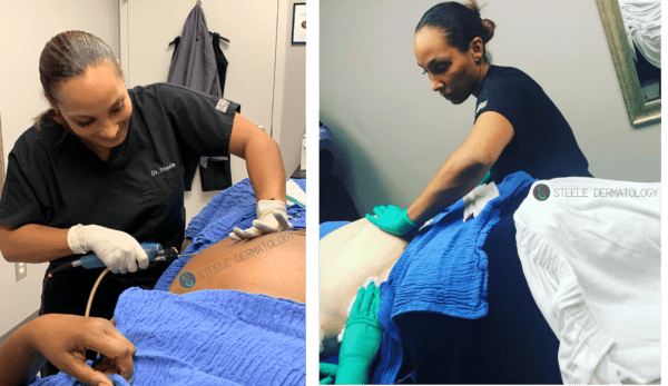 dr. steele-johnson performing liposuction surgery