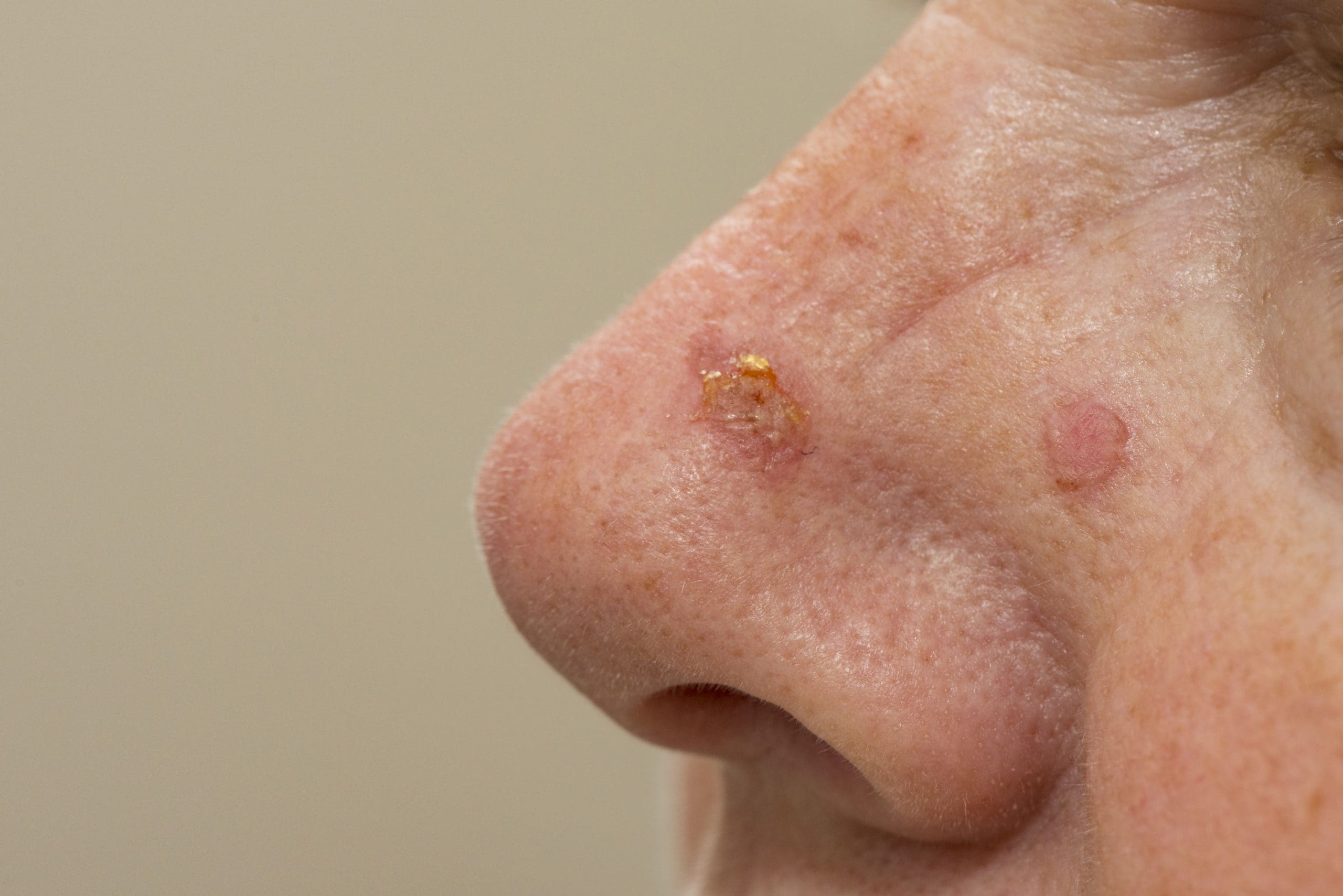 Skin cancer on face