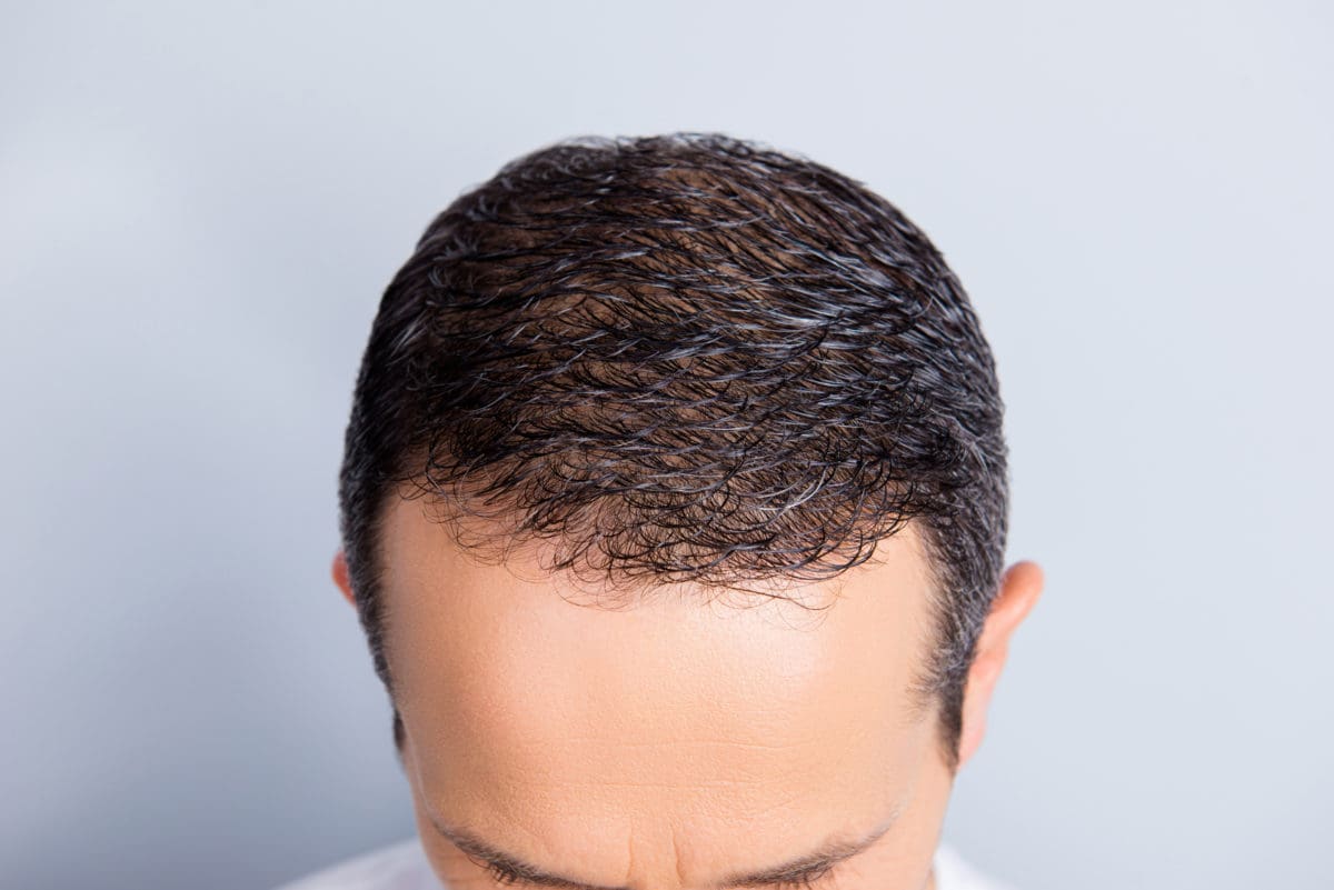 Keravive Scalp Treatment - Steele Dermatology Atlanta Alpharetta Georgia