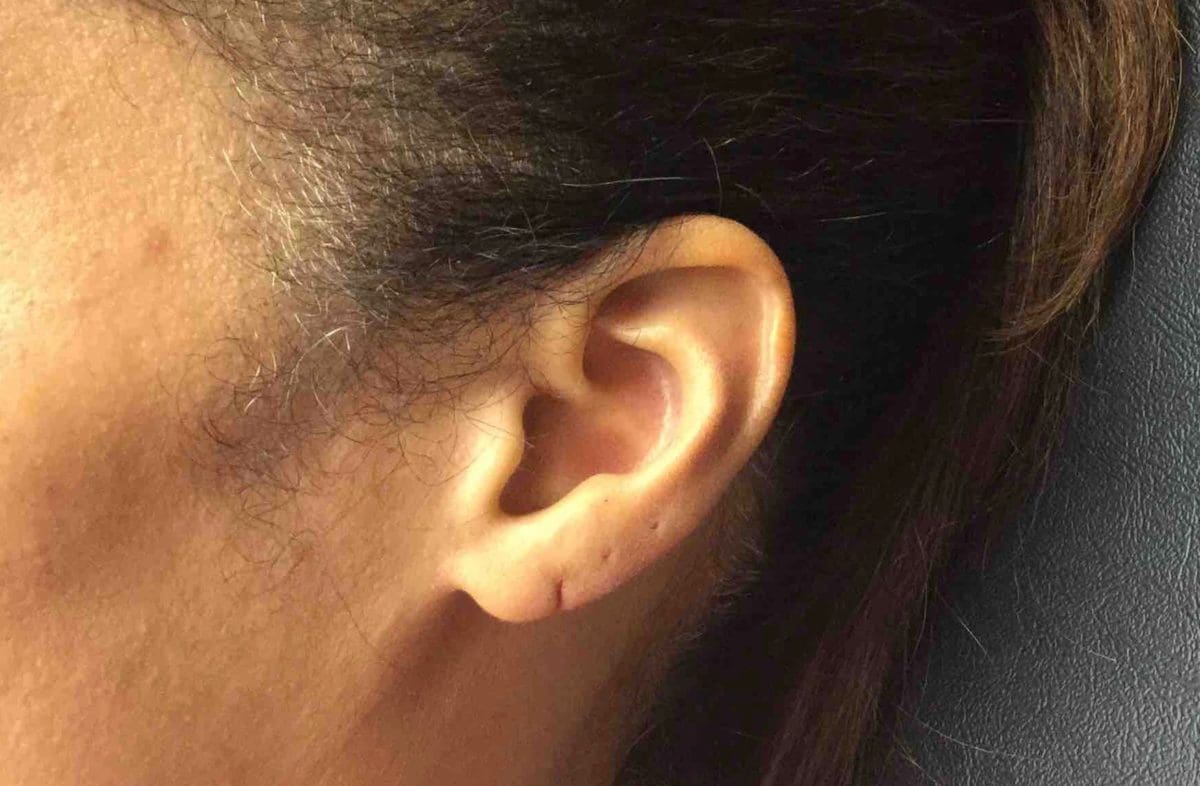 torn-earlobes-steele-dermatology-atlanta-alpharetta-georgia