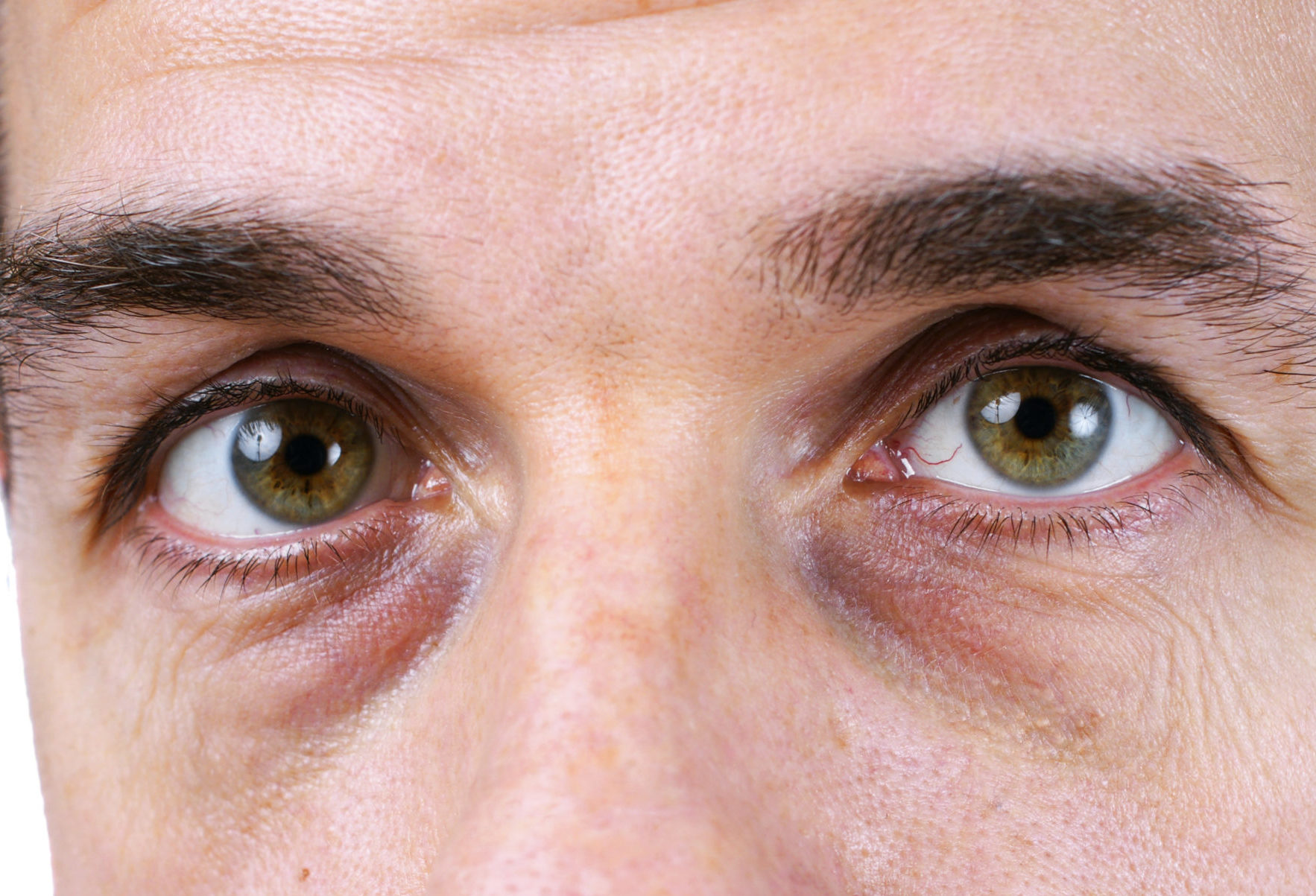 causes-of-under-eye-bags-and-their-treatments-smart-health-bay-the