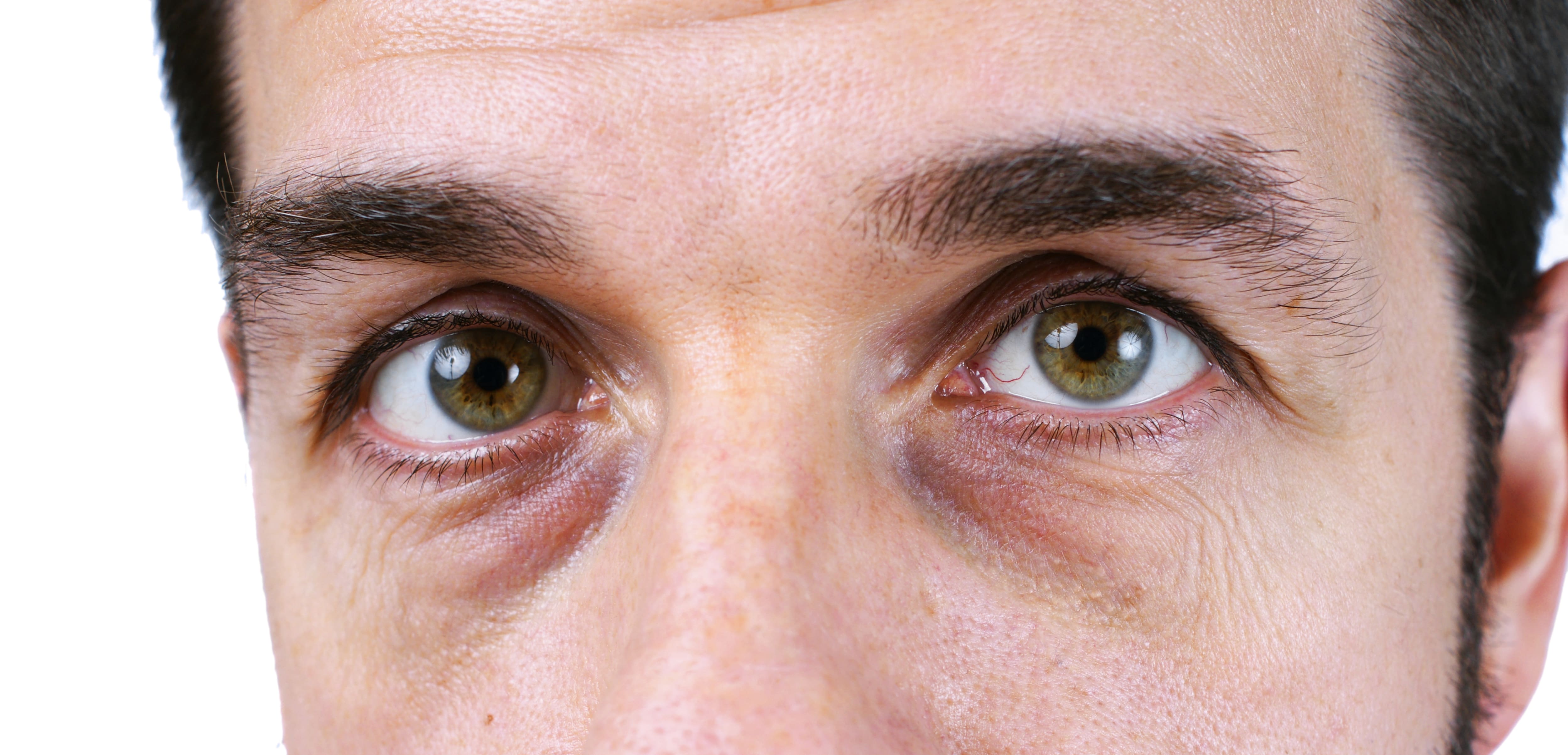 Under Eye Bags/Tired Eyes - Steele Dermatology Atlanta Alpharetta