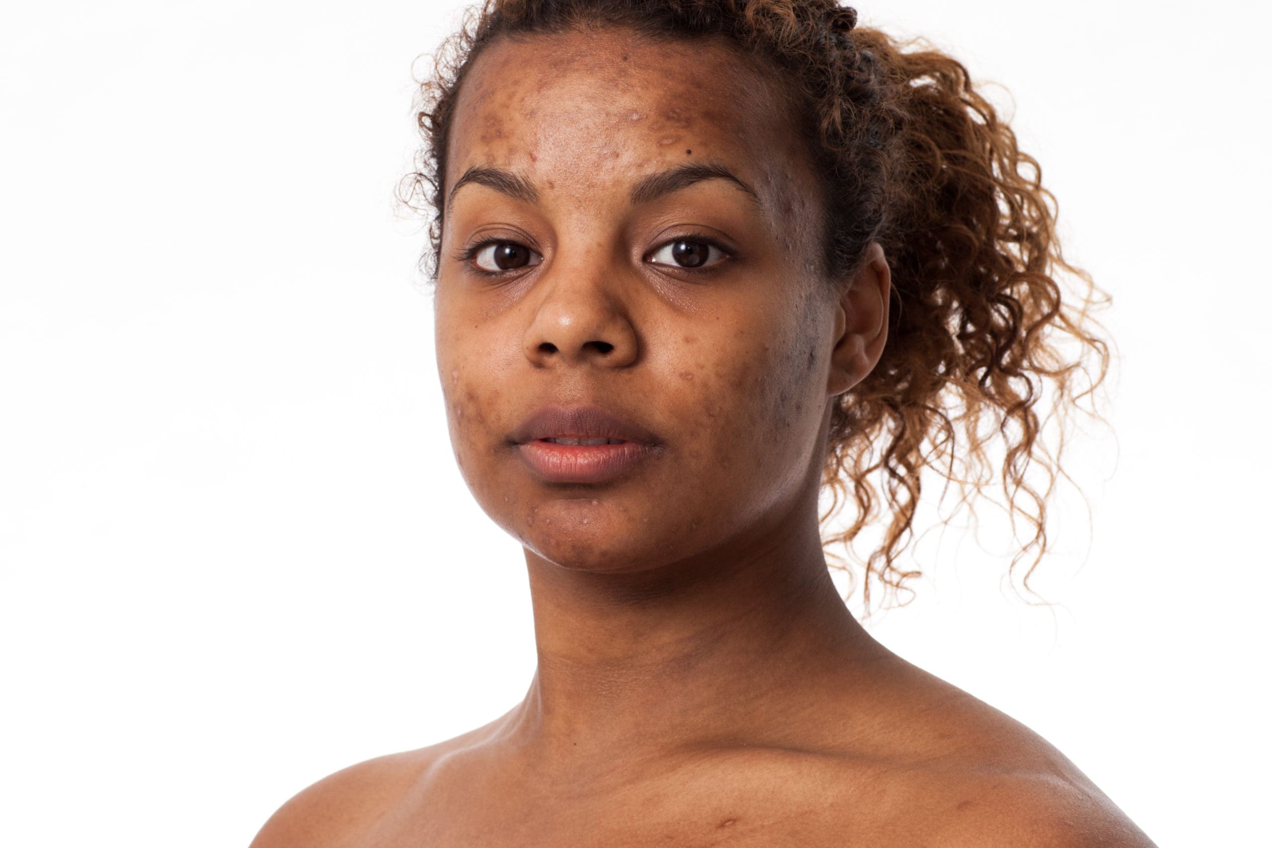 Blemishes and hyperpigmentation